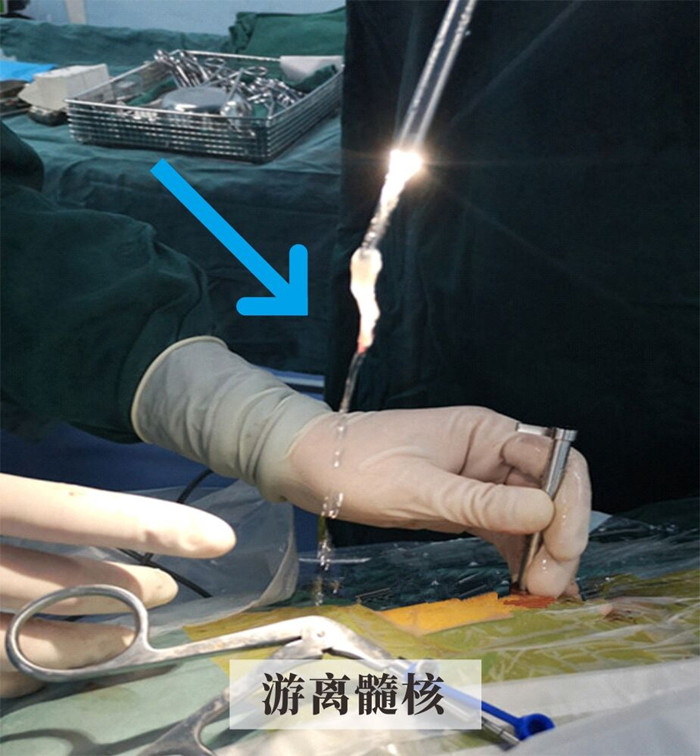 游离髓核.jpg