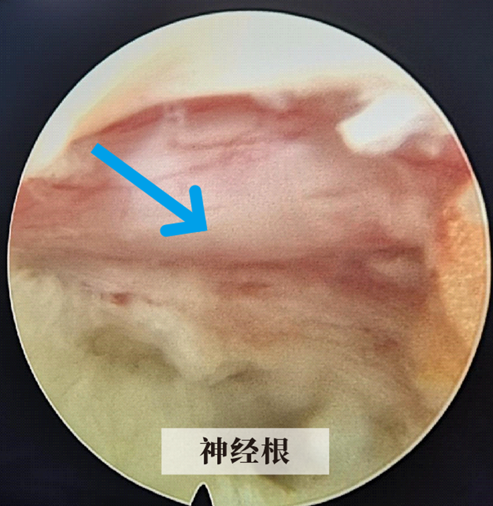 神经根.png