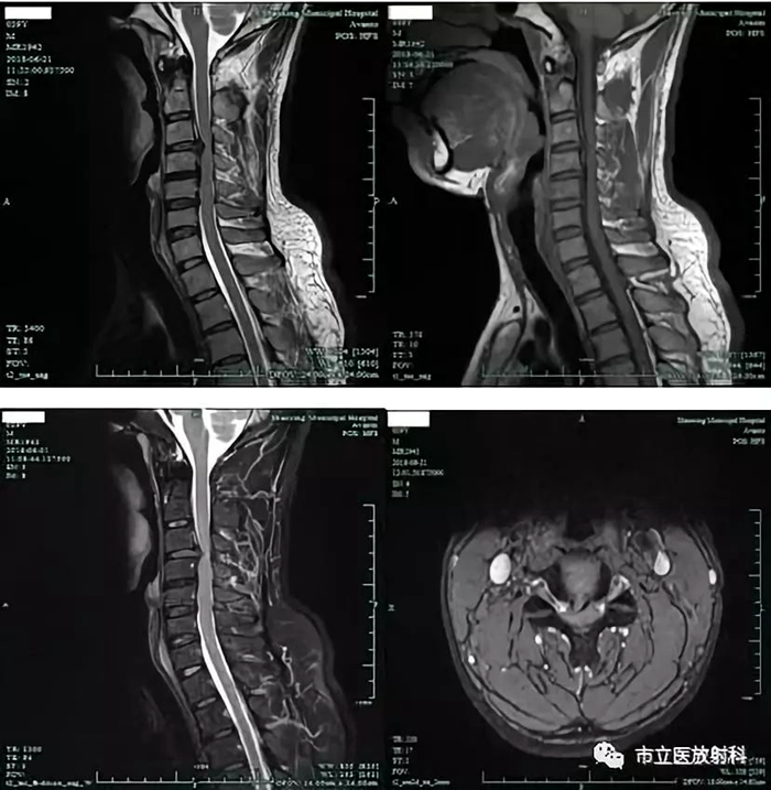 4颈椎MRI图像_副本.jpg 4颈椎MRI图像_副本.jpg